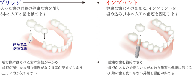 インプラントとブリッジ比較図