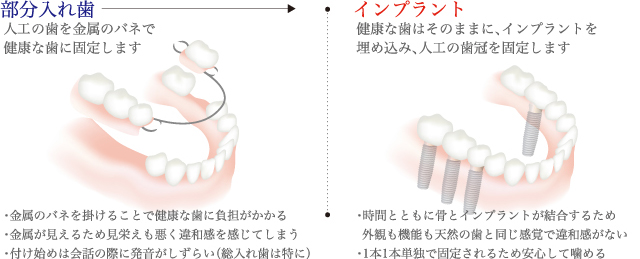 部分入れ歯との比較図