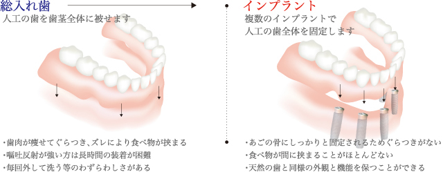 総入れ歯との比較